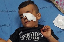 إصابة طفل بحروق في هجوم للمستوطنين على مسافر يطا والاحتلال يعتدي على شاب في حوارة