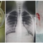 انقاذ حياة طفلين بعد اخراج ديدان من القصبات الهوائية في مجمع فلسطين الطبي برام الله
