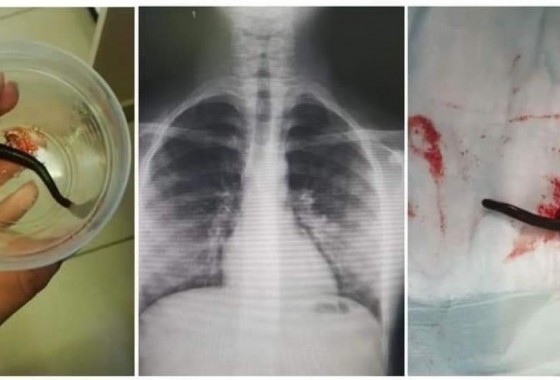انقاذ حياة طفلين بعد اخراج ديدان من القصبات الهوائية في مجمع فلسطين الطبي برام الله