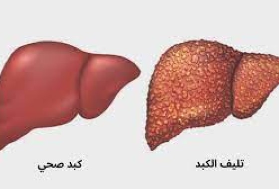 كيف نعرف علامات تليف الكبد وكيفية الوقاية منه